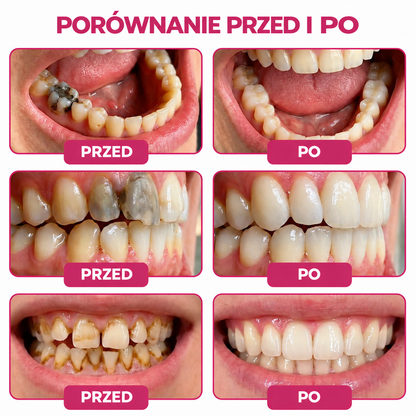 🇵🇱 Rolimey® DenPerm – Naturalny żel do odbudowy szkliwa i wypełniania ubytków